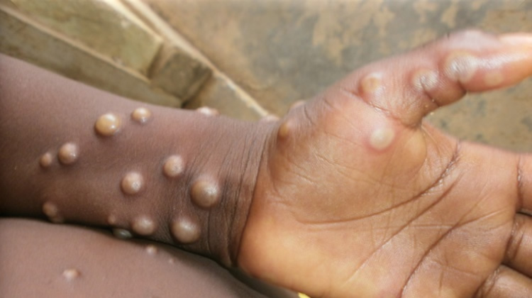 Mpox en Afrique : l'OMS décide mercredi s'il faut décréter "une urgence de santé publique" face à l'épidémie | Radio Algérienne