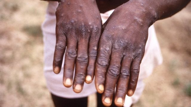 جدري القردة