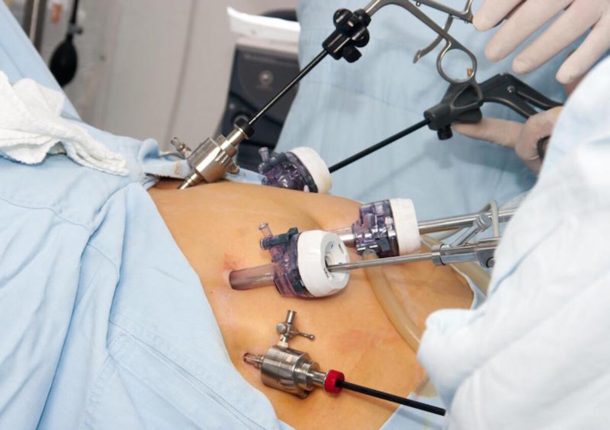 Laparoscopie opération