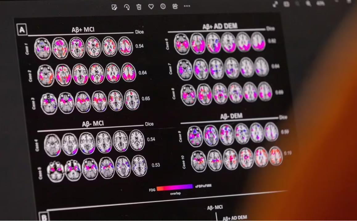 تحديد مجموعة بيانات بروتينية للبلازما تتنبأ بالخرف  قبل 15 عاما