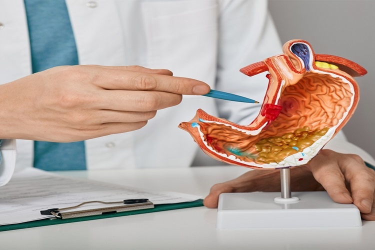 قرحة المعدة: طرق طبيعية للعلاج بدون أدوية