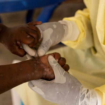 Les pays d'Afrique australe appellent à une action urgente contre la Mpox