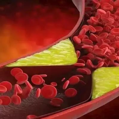 الكوليسترول 