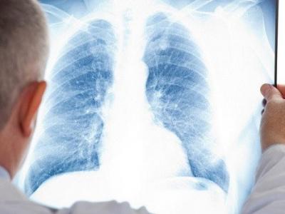 علاج لإبطاء المرض متوفر حاليا بالجزائر  