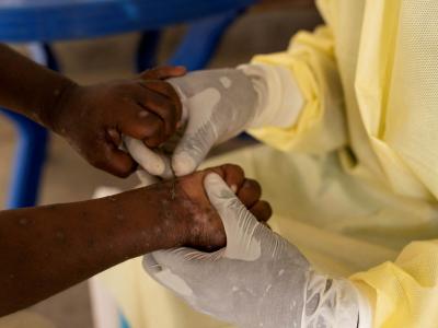 Les pays d'Afrique australe appellent à une action urgente contre la Mpox