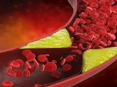 الكوليسترول 