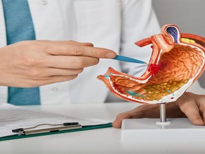 قرحة المعدة: طرق طبيعية للعلاج بدون أدوية 
